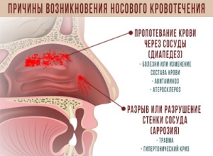 Что делать, если идет кровь из носа
